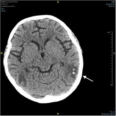 Posterior Reversible Encephalopathy Syndrome in a Patient With Microscopic Polyangiitis: A Case Report and Literature Review